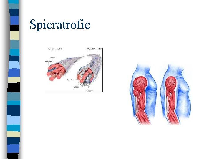 Spieratrofie 