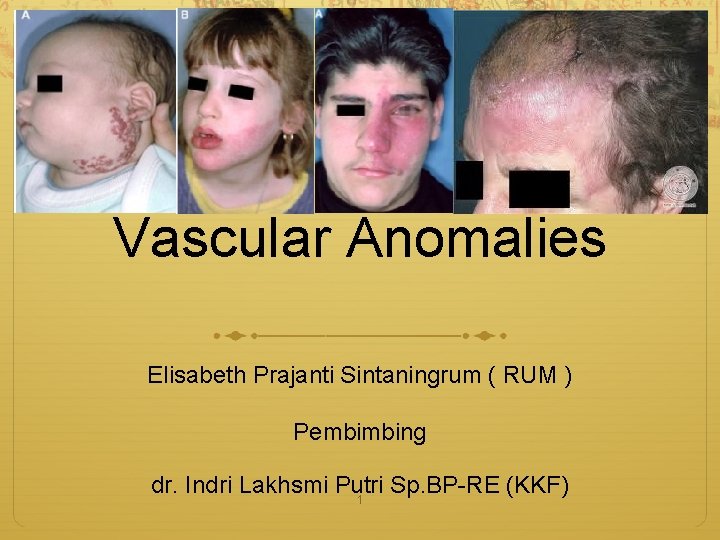 Vascular Anomalies Elisabeth Prajanti Sintaningrum ( RUM ) Pembimbing dr. Indri Lakhsmi Putri Sp.