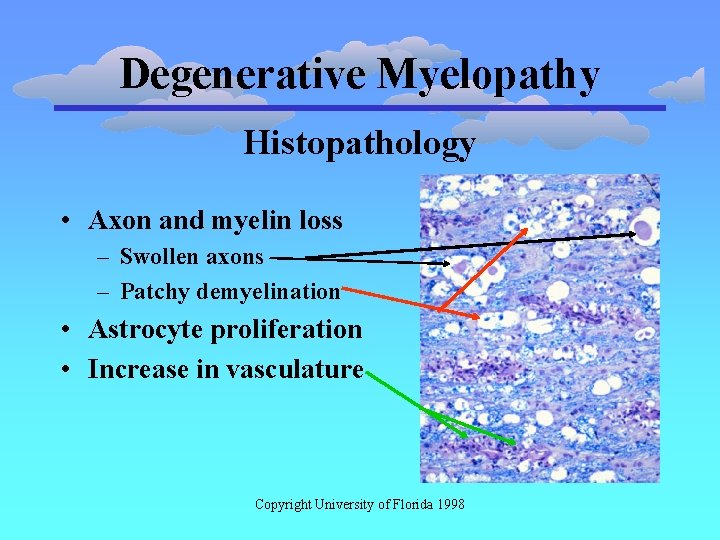 Degenerative Myelopathy Histopathology • Axon and myelin loss – Swollen axons – Patchy demyelination