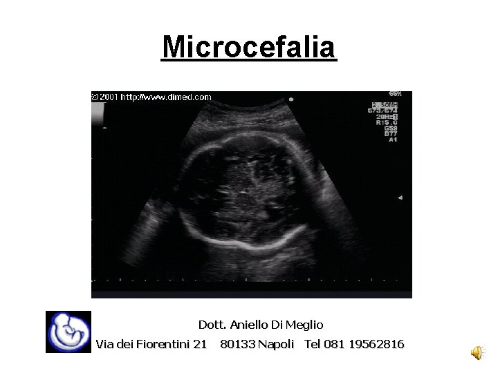 Microcefalia Dott. Aniello Di Meglio Via dei Fiorentini 21 80133 Napoli Tel 081 19562816