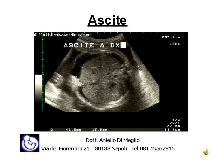 Ascite Dott. Aniello Di Meglio Via dei Fiorentini 21 80133 Napoli Tel 081 19562816