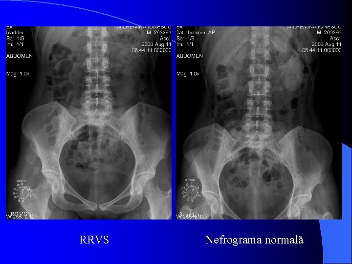 RRVS Nefrograma normală 