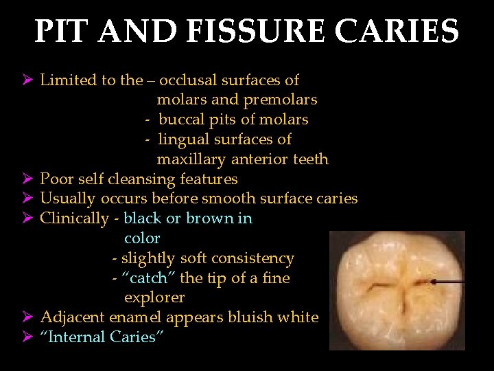 PIT AND FISSURE CARIES Ø Limited to the – occlusal surfaces of molars and