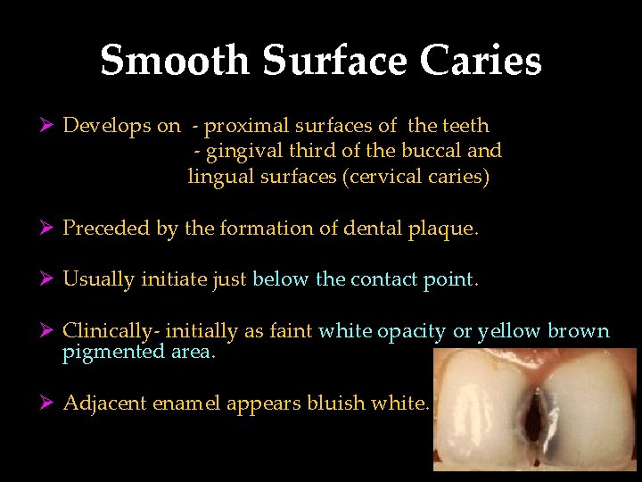 Smooth Surface Caries Ø Develops on - proximal surfaces of the teeth - gingival