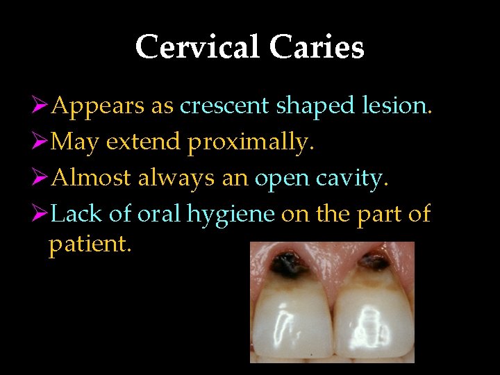 Cervical Caries ØAppears as crescent shaped lesion. ØMay extend proximally. ØAlmost always an open