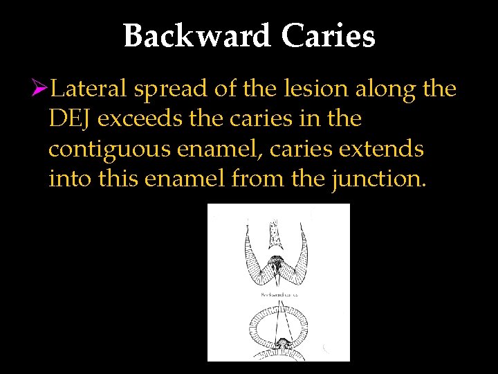 Backward Caries ØLateral spread of the lesion along the DEJ exceeds the caries in