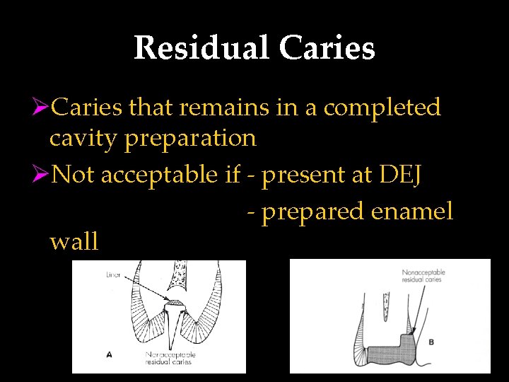 Residual Caries ØCaries that remains in a completed cavity preparation ØNot acceptable if -