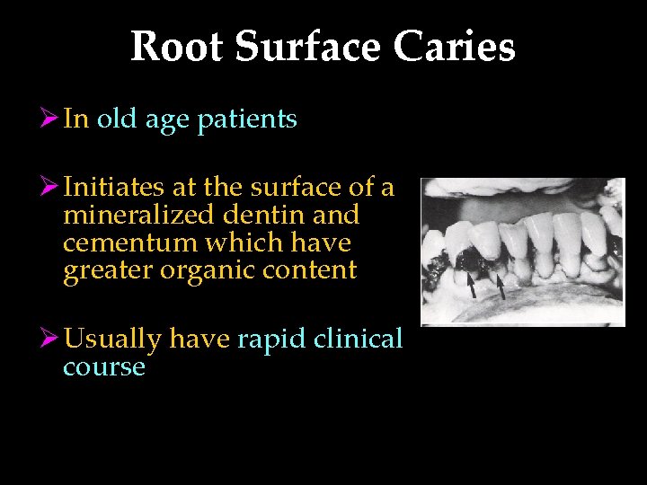 Root Surface Caries Ø In old age patients Ø Initiates at the surface of
