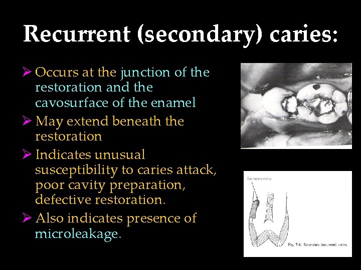 Recurrent (secondary) caries: Ø Occurs at the junction of the restoration and the cavosurface