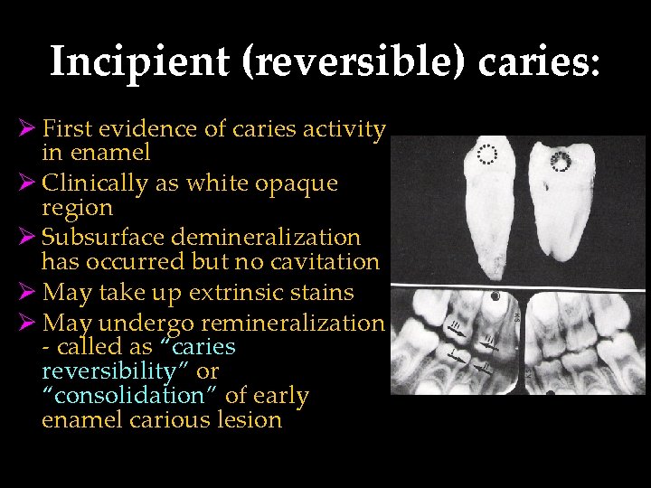 Incipient (reversible) caries: Ø First evidence of caries activity in enamel Ø Clinically as