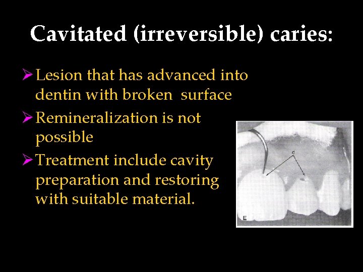 Cavitated (irreversible) caries: Ø Lesion that has advanced into dentin with broken surface Ø
