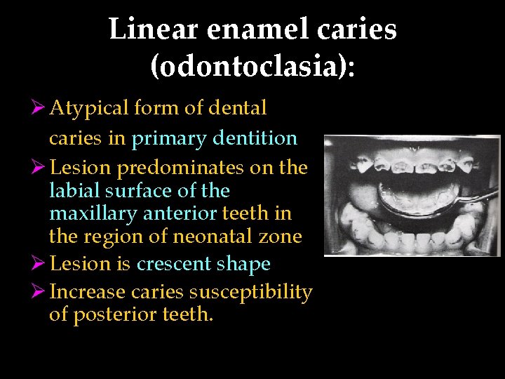 Linear enamel caries (odontoclasia): Ø Atypical form of dental caries in primary dentition Ø