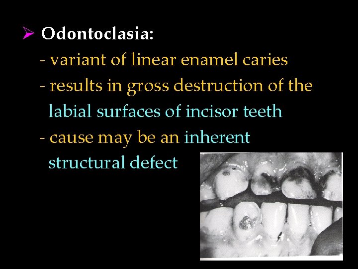 Ø Odontoclasia: - variant of linear enamel caries - results in gross destruction of