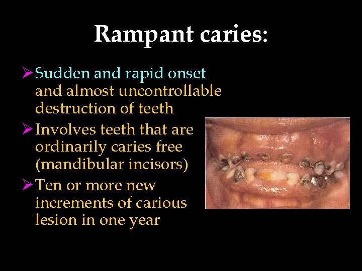 Rampant caries: Ø Sudden and rapid onset and almost uncontrollable destruction of teeth Ø