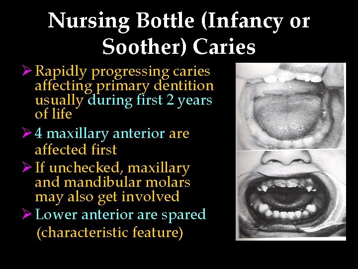 Nursing Bottle (Infancy or Soother) Caries Ø Rapidly progressing caries affecting primary dentition usually