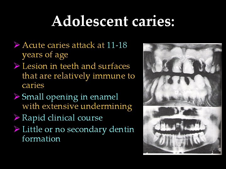 Adolescent caries: Ø Acute caries attack at 11 -18 years of age Ø Lesion