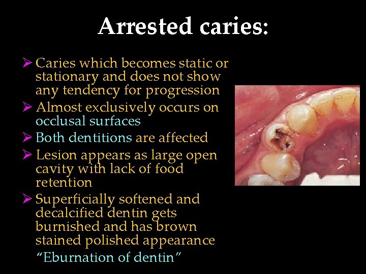 Arrested caries: Ø Caries which becomes static or stationary and does not show any