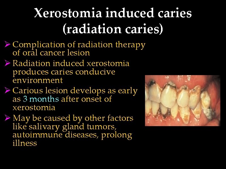 Xerostomia induced caries (radiation caries) Ø Complication of radiation therapy of oral cancer lesion