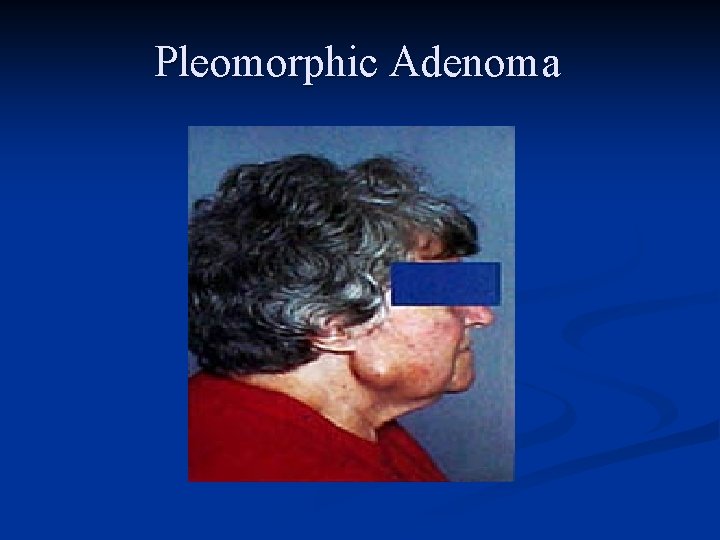 Pleomorphic Adenoma 