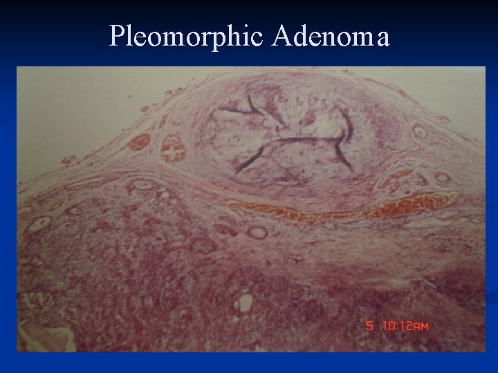 Pleomorphic Adenoma 