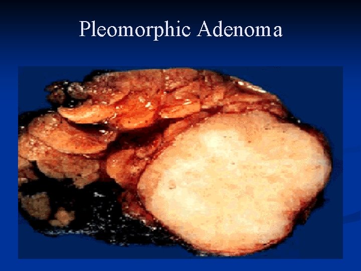 Pleomorphic Adenoma 