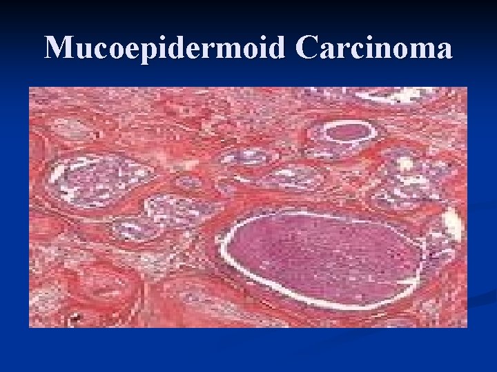 Mucoepidermoid Carcinoma 