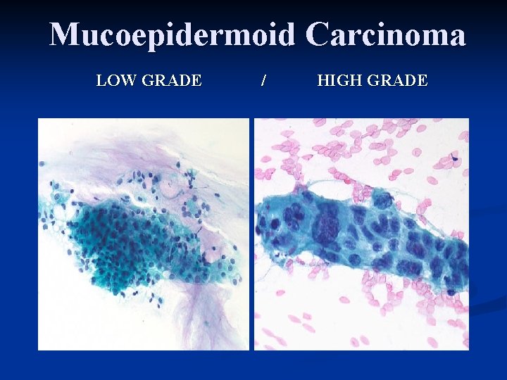 Mucoepidermoid Carcinoma LOW GRADE / HIGH GRADE 