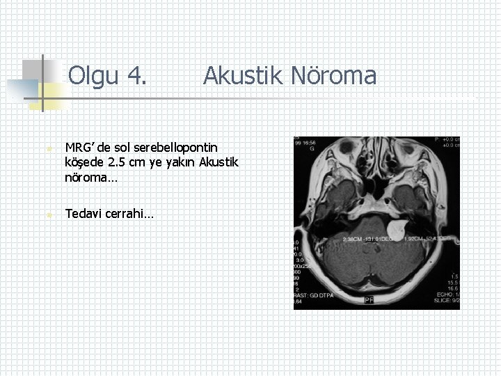 Olgu 4. n n Akustik Nöroma MRG’ de sol serebellopontin köşede 2. 5 cm