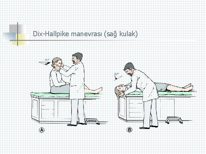 Dix-Hallpike manevrası (sağ kulak) 