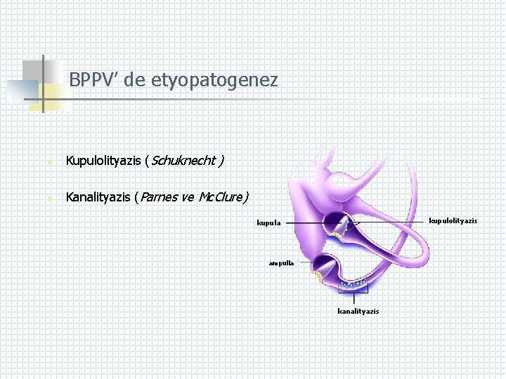 BPPV’ de etyopatogenez n Kupulolityazis (Schuknecht ) n Kanalityazis (Parnes ve Mc. Clure) kupulolityazis