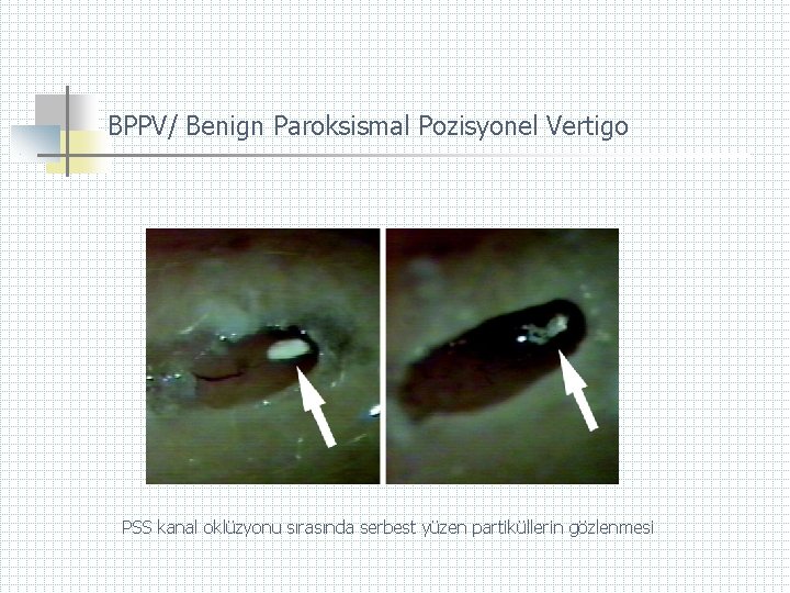 BPPV/ Benign Paroksismal Pozisyonel Vertigo PSS kanal oklüzyonu sırasında serbest yüzen partiküllerin gözlenmesi 