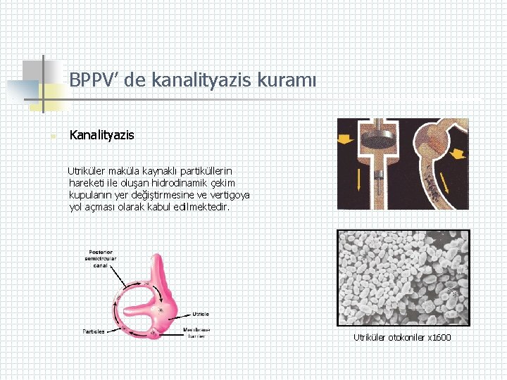 BPPV’ de kanalityazis kuramı n Kanalityazis Utriküler maküla kaynaklı partiküllerin hareketi ile oluşan hidrodinamik