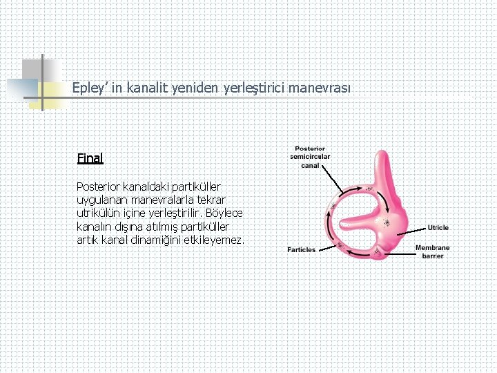 Epley’ in kanalit yeniden yerleştirici manevrası Final Posterior kanaldaki partiküller uygulanan manevralarla tekrar utrikülün