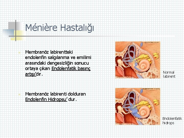 Ménière Hastalığı n n Membranöz labirentteki endolenfin salgılanma ve emilimi arasındaki dengesizliğin sonucu ortaya
