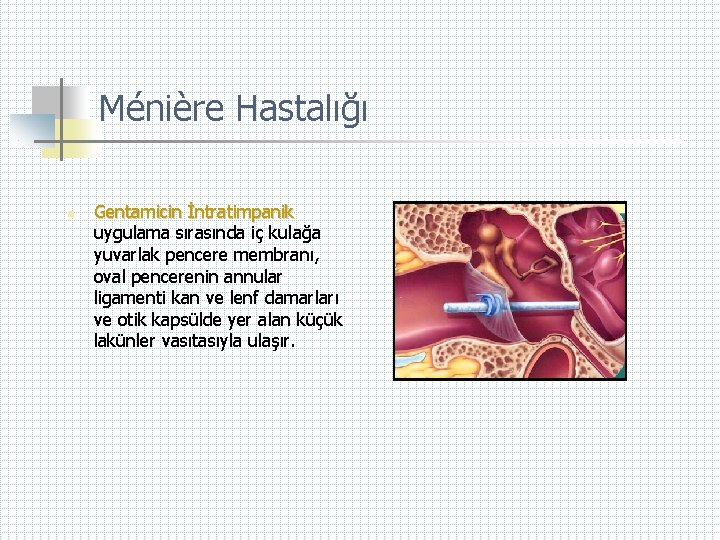 Ménière Hastalığı n Gentamicin İntratimpanik uygulama sırasında iç kulağa yuvarlak pencere membranı, oval pencerenin