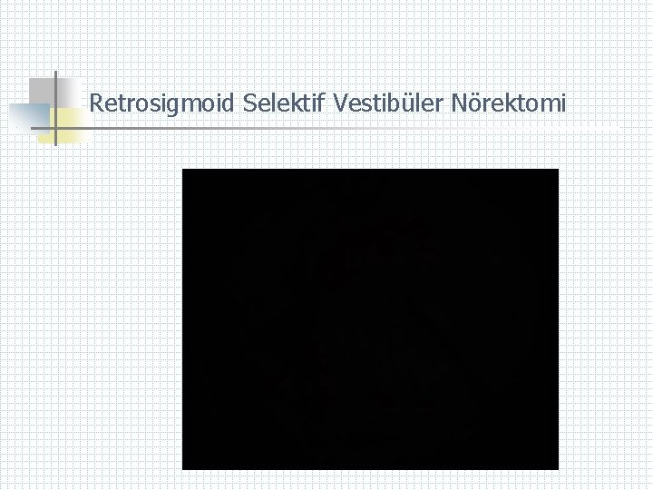 Retrosigmoid Selektif Vestibüler Nörektomi 