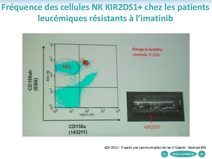 Fréquence des cellules NK KIR 2 DS 1+ chez les patients leucémiques résistants à