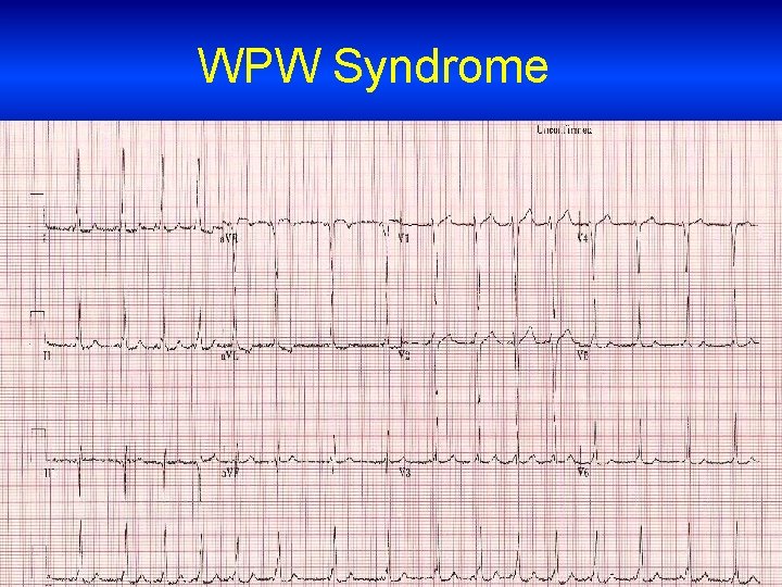 WPW Syndrome 