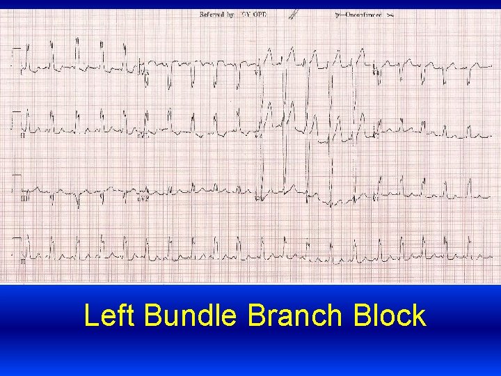 Left Bundle Branch Block 