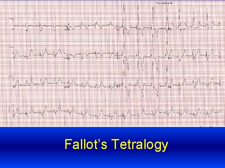 Fallot’s Tetralogy 