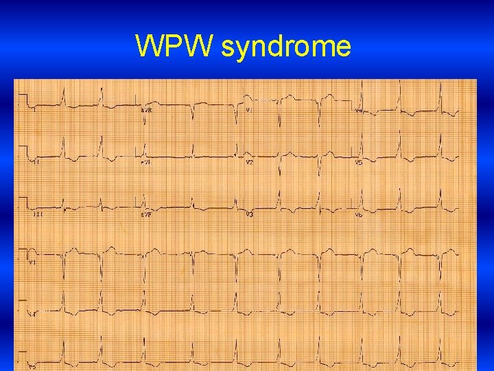 WPW syndrome 