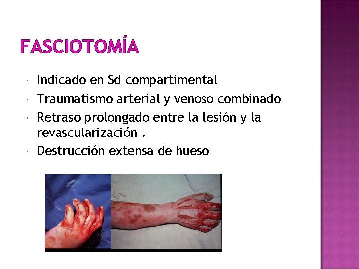 FASCIOTOMÍA Indicado en Sd compartimental Traumatismo arterial y venoso combinado Retraso prolongado entre la