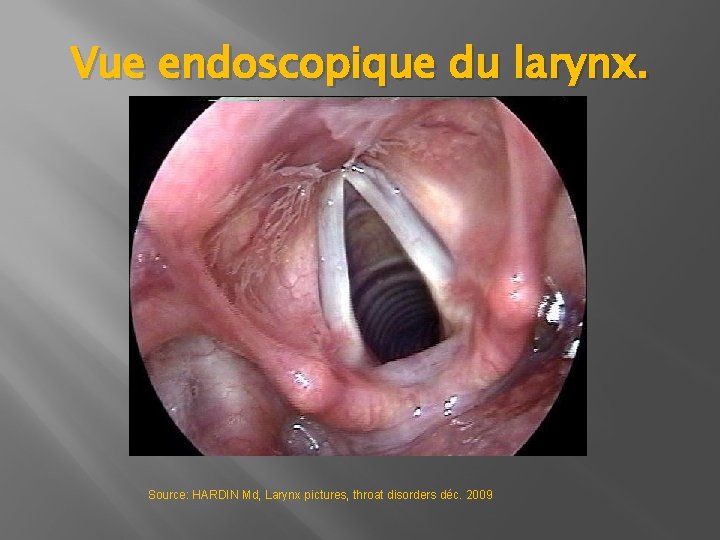 Vue endoscopique du larynx. Source: HARDIN Md, Larynx pictures, throat disorders déc. 2009 Vue endoscopique du larynx. Source: HARDIN Md, Larynx pictures, throat disorders déc. 2009