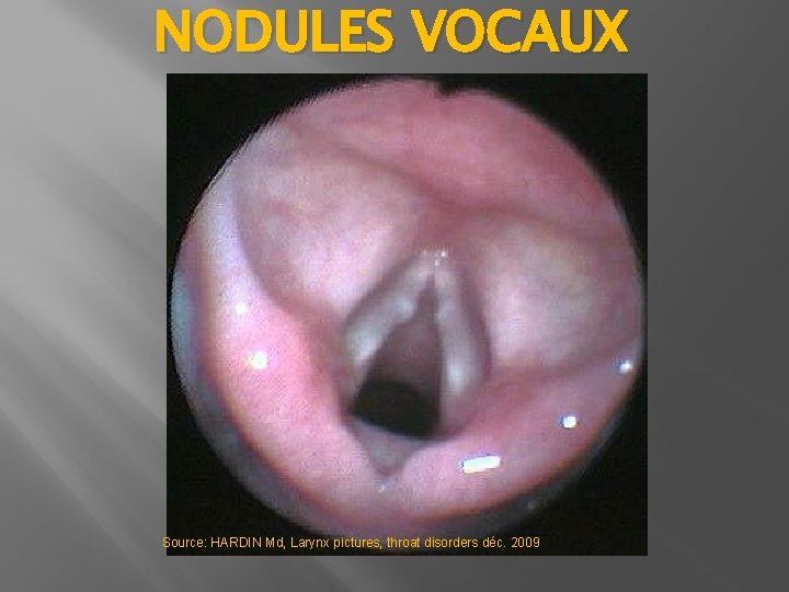 NODULES VOCAUX Source: HARDIN Md, Larynx pictures, throat disorders déc. 2009 NODULES VOCAUX Source: HARDIN Md, Larynx pictures, throat disorders déc. 2009