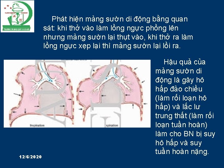 Phát hiện mảng sườn di động bằng quan sát: khi thở vào làm lồng