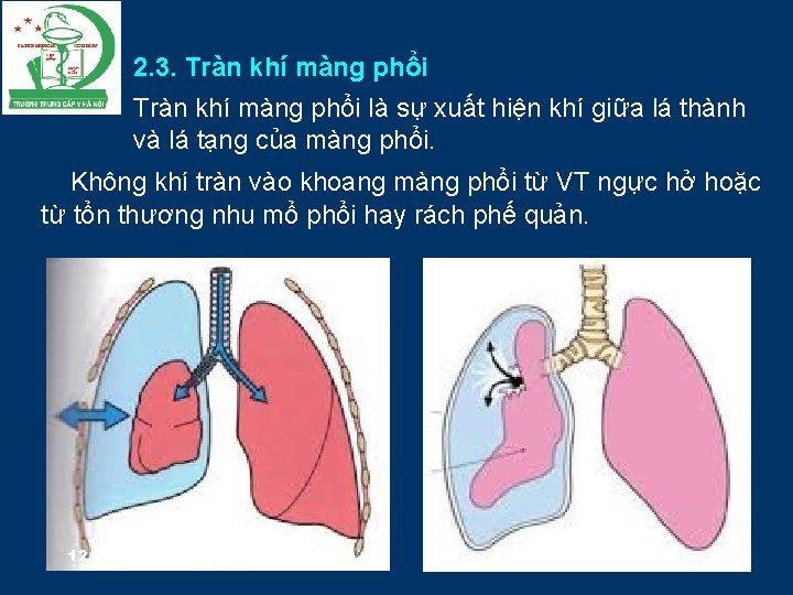 2. 3. Tràn khí màng phổi là sự xuất hiện khí giữa lá thành