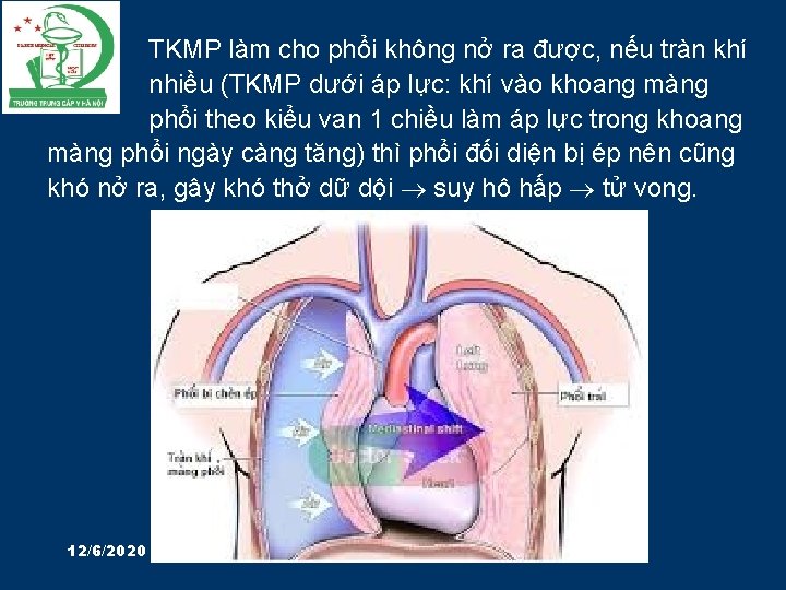TKMP làm cho phổi không nở ra được, nếu tràn khí nhiều (TKMP dưới