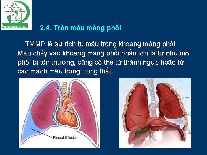 2. 4. Tràn máu màng phổi TMMP là sự tích tụ máu trong khoang