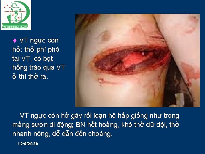  VT ngực còn hở: thở phì phò tại VT, có bọt hồng trào