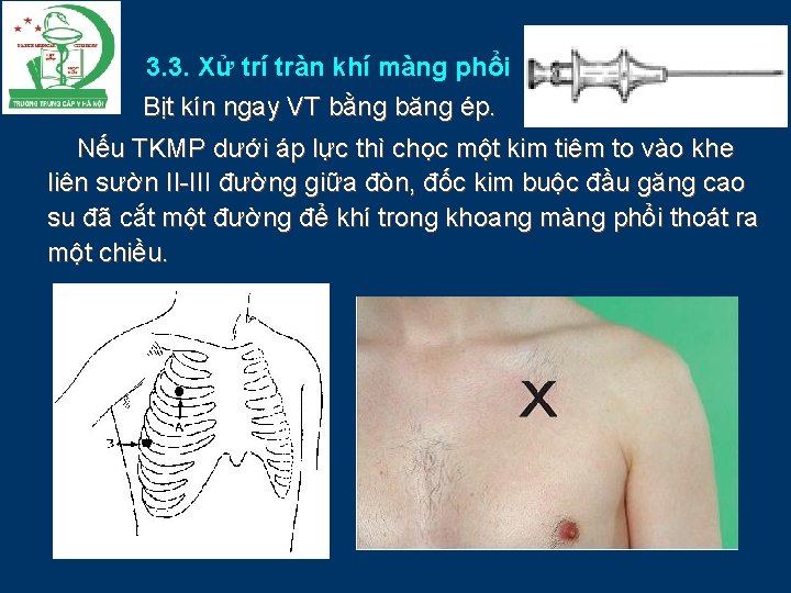 3. 3. Xử trí tràn khí màng phổi Bịt kín ngay VT bằng băng